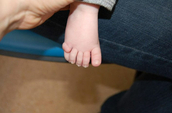 Picture of Extra Fingers or Toes? Scientists Pinpoint a Genetic Culprit